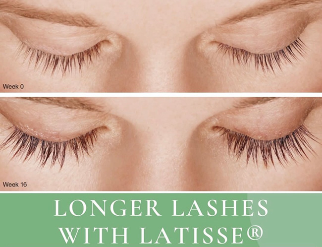Longer Lashes with LATISSE