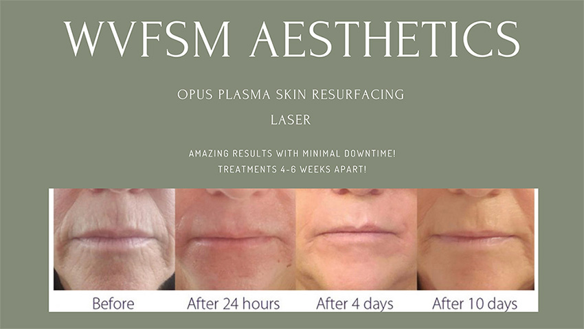 WVFSM Aesthetics, Opus Plasma Skin Resurfacing Laser. Amazing results with minimal downtime! Treatments 4-6 months apart!